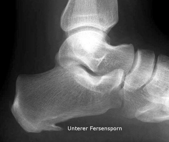 dionysBEWEGT - Dionys Schwery | Röntgenaufnahme eines Fersenspornes